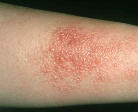 CONTACT DERMATITIS – Dermatology Conditions and Treatments