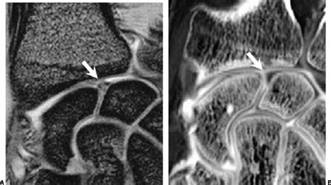 Scapholunate Ligament Mri