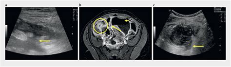 1.9 year old patient with terminal ileitis and enteroenteric fistulae... | Download Scientific ...