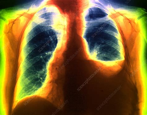 Hydropneumothorax, X-ray - Stock Image - M170/0256 - Science Photo Library