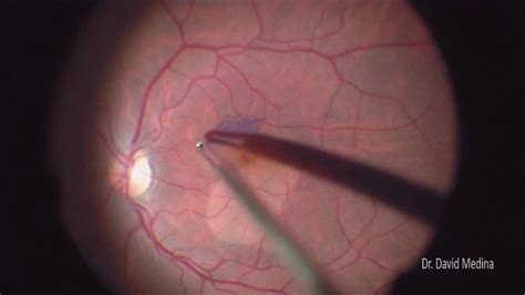 Macular Hole Surgery - YouTube