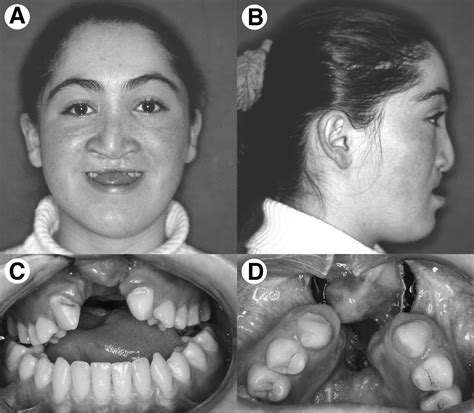 Maxillary Anterior Segmental Advancement of Hypoplastic Maxilla in Cleft Patients by Distraction ...