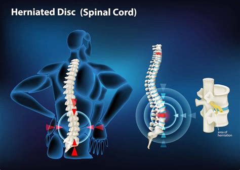 Herniated Disc Exercises: Stretches & Exercise for Slip Disc | Seema