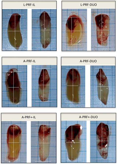 Standardized pictures and measurements of the clots and membranes. The ...