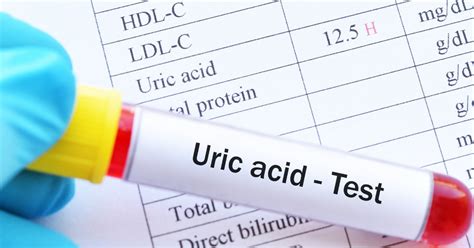 SERUM URIC ACID – LabTest