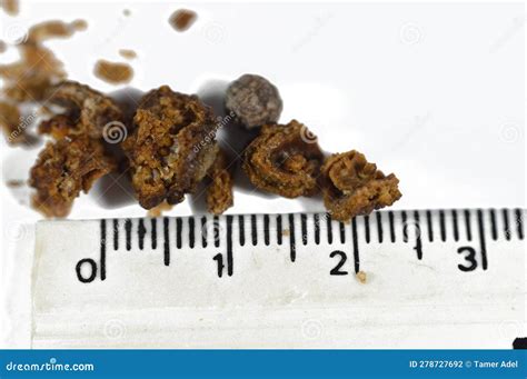 Nephrolithiasis, Irregular Brown Kidney Stones (renal Calculus or Nephrolith), the Stones are ...