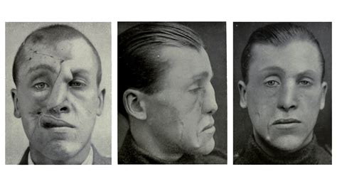 Innovative Cosmetic Surgery Restored WWI Vets' Ravaged Faces—And Lives ...