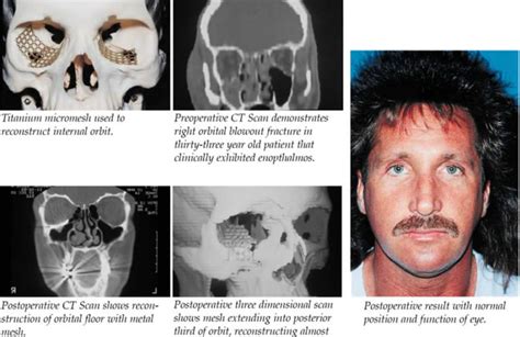 Orbital Fractures