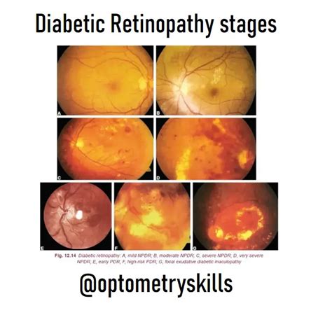 Diabetic Retinopathy stages - An Eye Care Blog