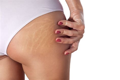 Stretch Marks? The Science Behind The Cause And How To Treat Them