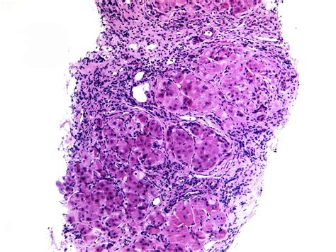 Liver Disease Histology