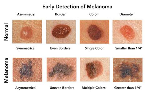 Melanoma Skin Cancer Signs