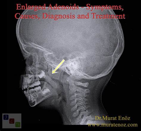 Enlarged Adenoids - Symptoms, Causes, Diagnosis and Treatment