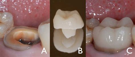 ¿POR QUE UNA ENDOCORONA TRAS UNA ENDODONCIA? - Dentistas en Pamplona y clinica dental en Pamplona