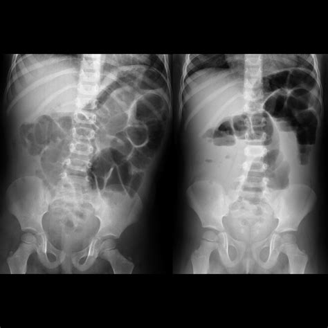 Preschooler with abdominal pain, diarrhea, emesis | Pediatric Radiology Case | Pediatric Imaging ...