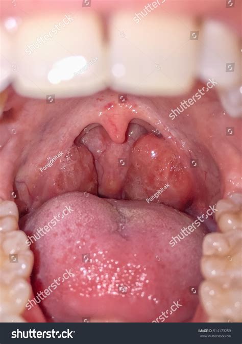 Holes In Tonsils: Causes, Symptoms, And Treatment, 56% OFF