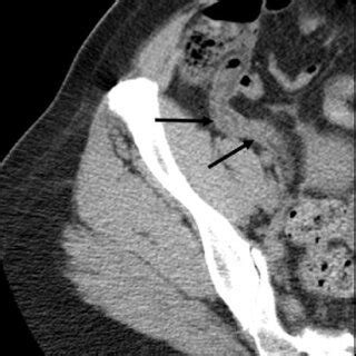 year-old boy with acute appendicitis. CT with oral contrast material ...