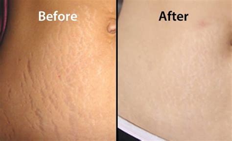 Stretch Marks Removal Treatment via Laser - Jaipur Skincity