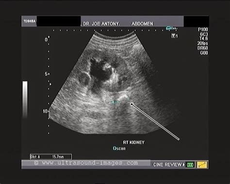 cochinblogs: A large ureteric calculus