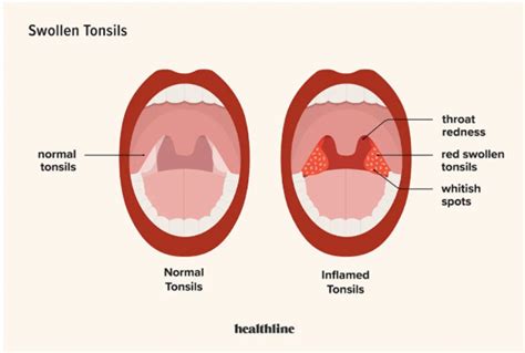 Tonsils and Adenoids