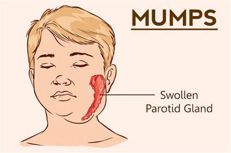 Treatment for Mumps - MEDizzy