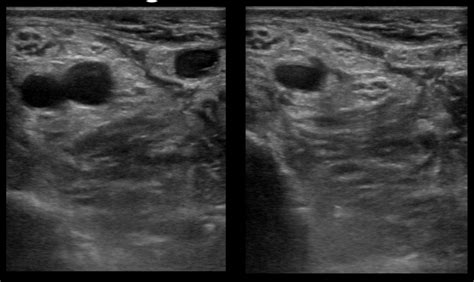 Upper Extremity DVT | Emory School of Medicine