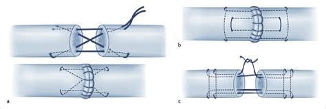 4 Flexor Tendon Repair (Zone 2) | Plastic Surgery Key