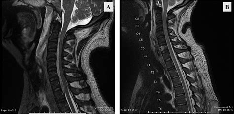 Anterior transcorporeal full-endoscopic drainage of a long-span ventral cervical epidural ...