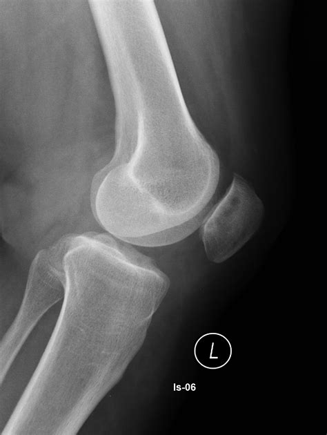 Chondromalacia patella | Image | Radiopaedia.org