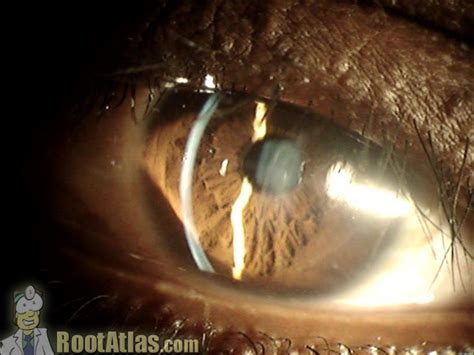 Rizzuti's corneal light reflex seen in keratoconus (Video) - TimRoot.com