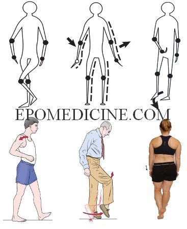 Examination of Gait | Epomedicine