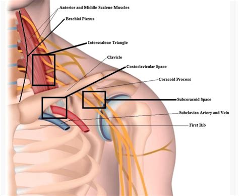 Thoracic Outlet Syndrome - Symptoms, Causes & Types