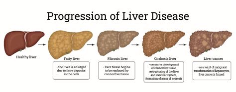 Liver Fibrosis & Cirrhosis in Singapore - Gastrohealth Clinic