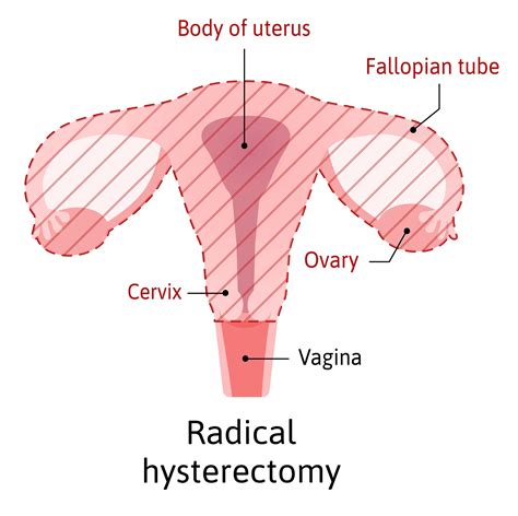 Hysterectomy: Reasons, Types, and Risks - Ask Dr. Angela