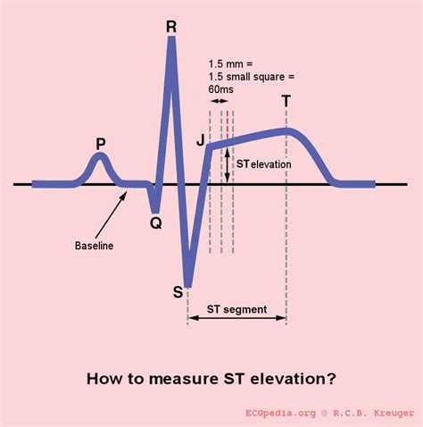 ST interval - wikidoc | Medical school stuff, Emergency medicine, Cardiac nursing