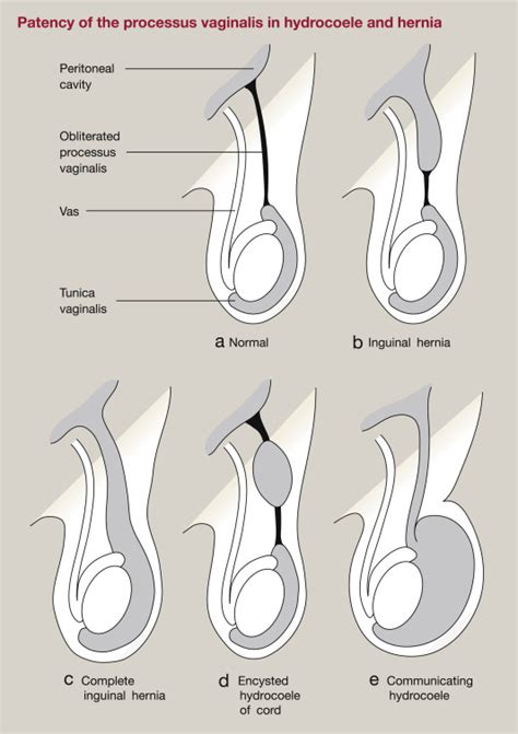 Congenital inguinal hernia, hydrocoele and undescended testis - Surgery ...