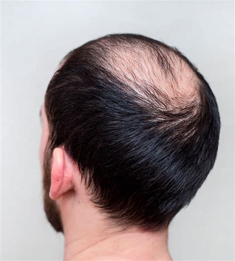 Álbumes 91+ Foto Cortes De Cabello Para Hombre Con Alopecia El último