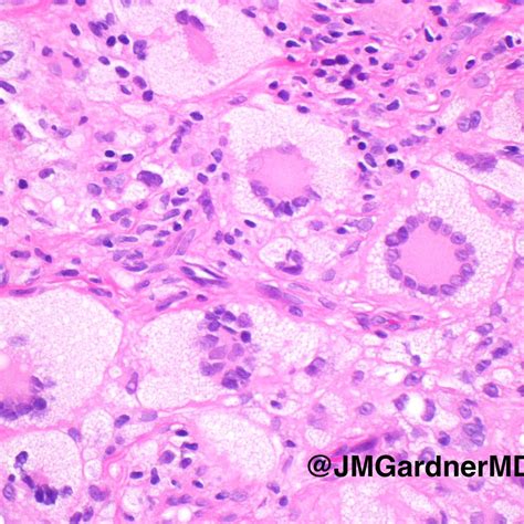 Juvenile Xanthogranuloma Histology