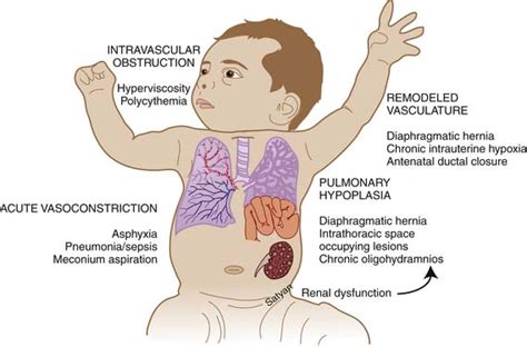 Pulmonary Hypoplasia In Newborn