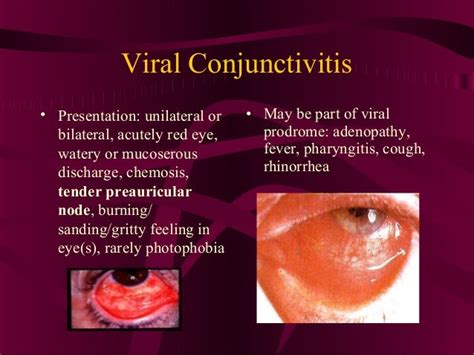 Conjunctivitis