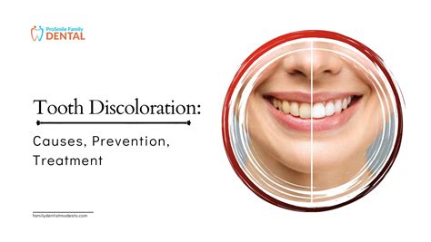 Tooth Discoloration - Causes, Prevention, Treatment