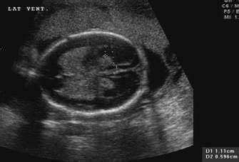 Lobar Holoprosencephaly | Sonography student, Ultrasound, Sonography