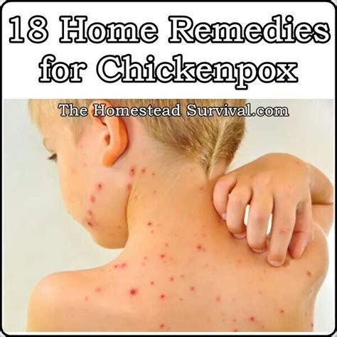 CHICKEN POX HOME REMEDIES | Home remedies, Remedies, Preventative health