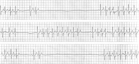 Sinus Node Dysfunction (Sick Sinus Syndrome) • LITFL • ECG Library