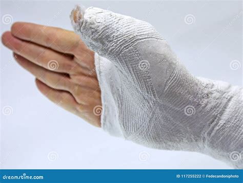 Fracture of the Thumb Due To an Accident Stock Photo - Image of hospital, medical: 117255222