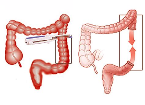 Colon Surgery for Cancer Patients - Best General Surgeons NYC