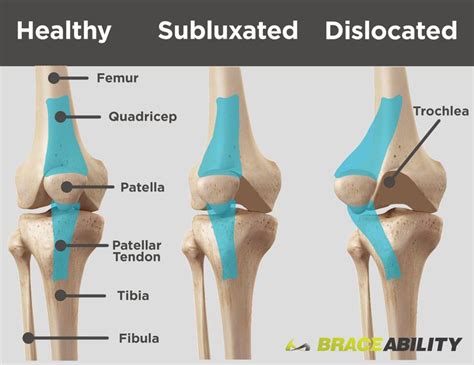 Use this diagram to see the difference between a subluxated kneecap and one that is fully ...