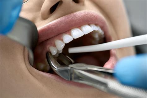 🦷️ Full Mouth Extractions - A Complete Guide By Dr. Jasmine Naderi