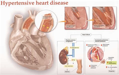 Hypertensive heart disease causes, symptoms, diagnosis & treatment