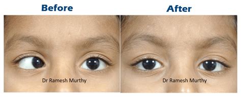 How Can Squint Surgery Be Made Successful - Dr. Ramesh Murthy